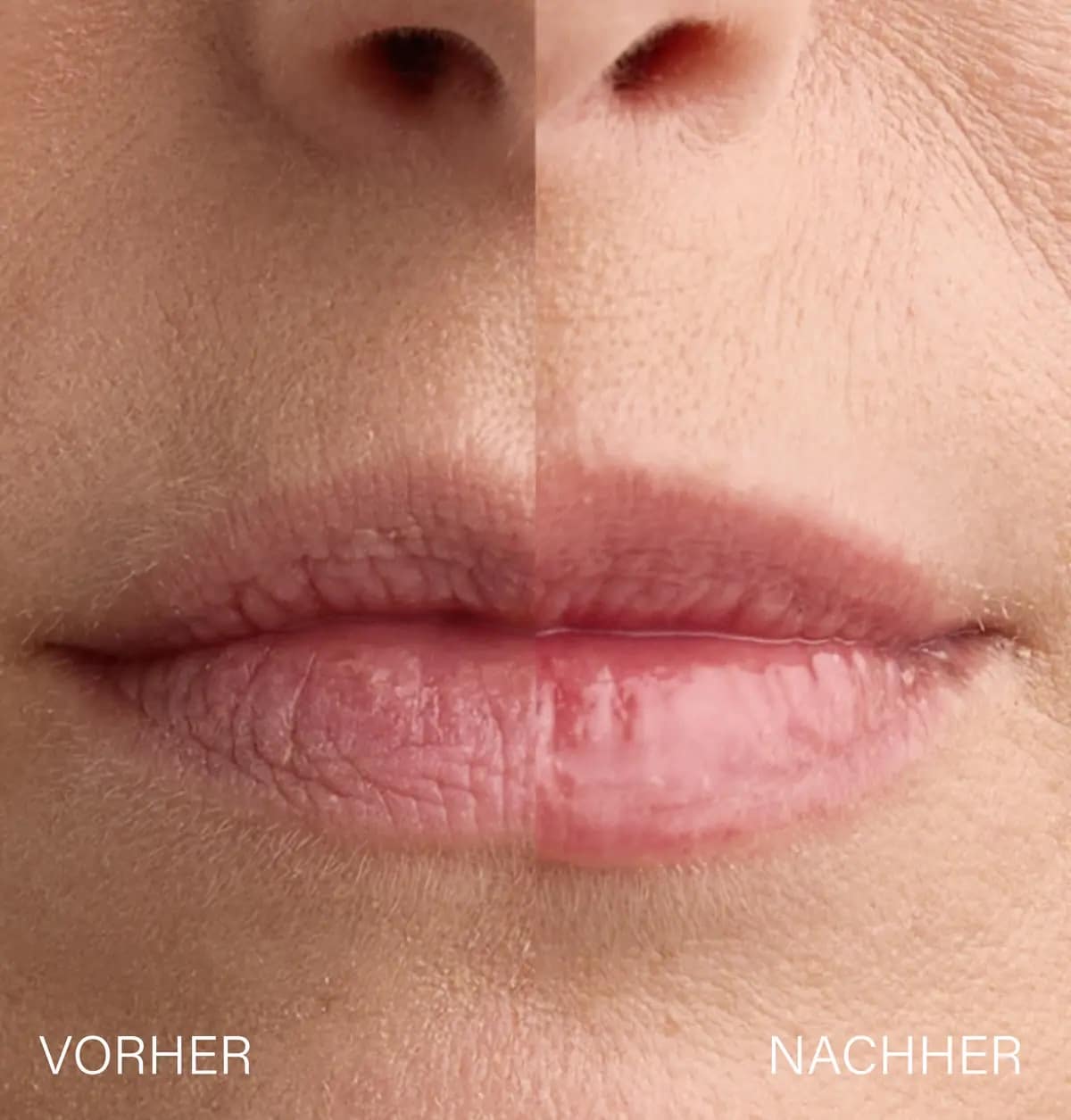 Wissenschaftlicher Vorher-Nachher-Vergleich der Lippenkontur und des Volumens nach Lip Plumper Anwendung.